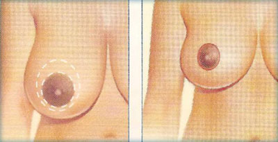 جراحی کوچک کردن سینه در گیلان