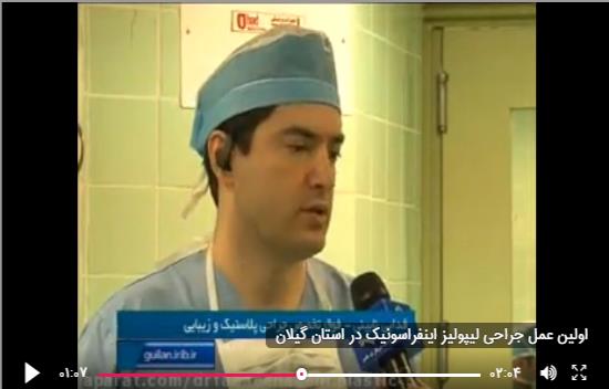 اولین عمل جراحی لیپولیز اینفراسونیک در استان گیلان 