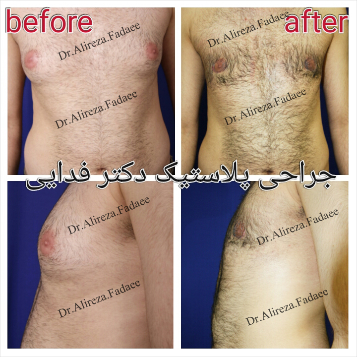 (ژنیکوماستی) دکتر علیرضا فدایی نایینی فوق تخصص جراحی پلاستیک