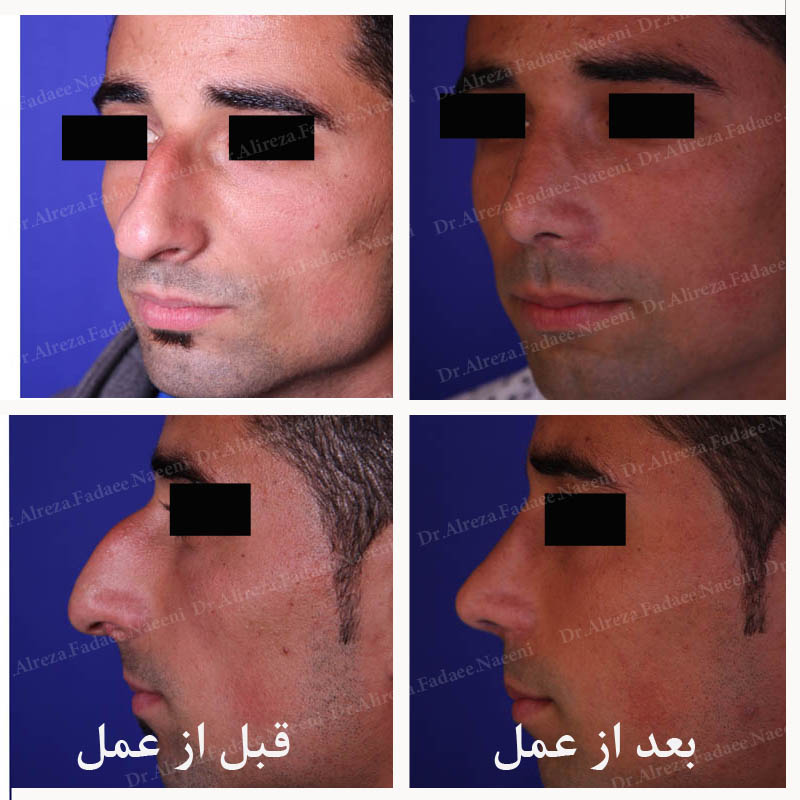 (عمل بینی) دکتر علیرضا فدایی نایینی فوق تخصص جراحی پلاستیک 