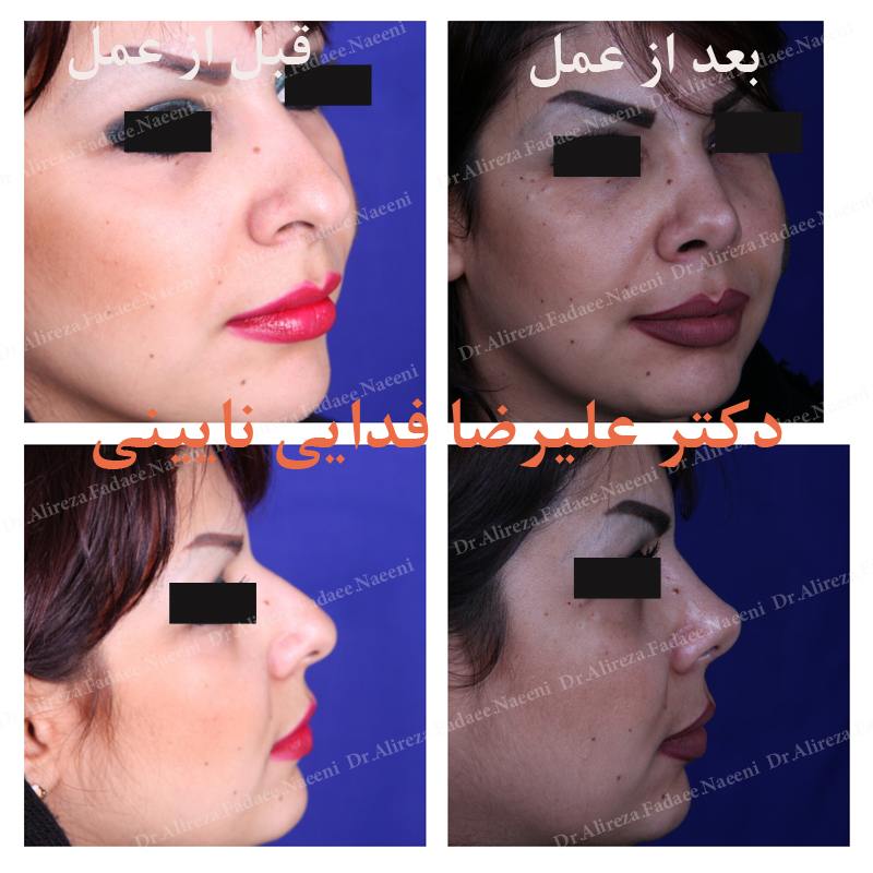 (عمل بینی) دکتر علیرضا فدایی نایینی فوق تخصص جراحی پلاستیک 