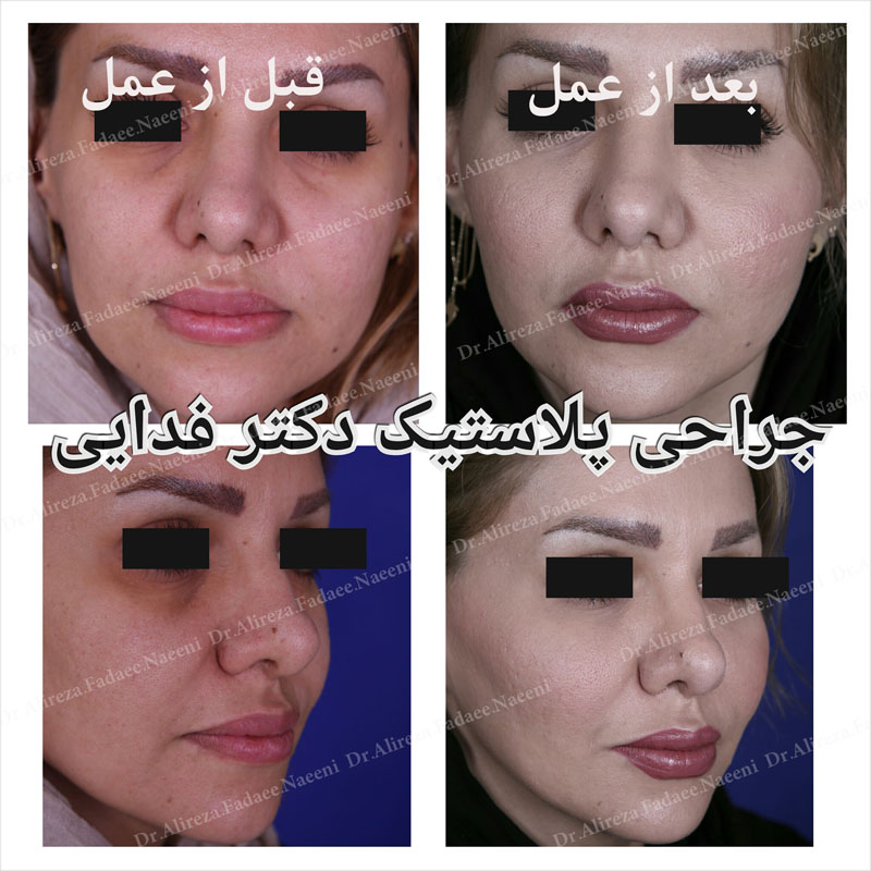 (تزریق چربی) دکتر علیرضا فدایی نایینی فوق تخصص جراحی پلاستیک