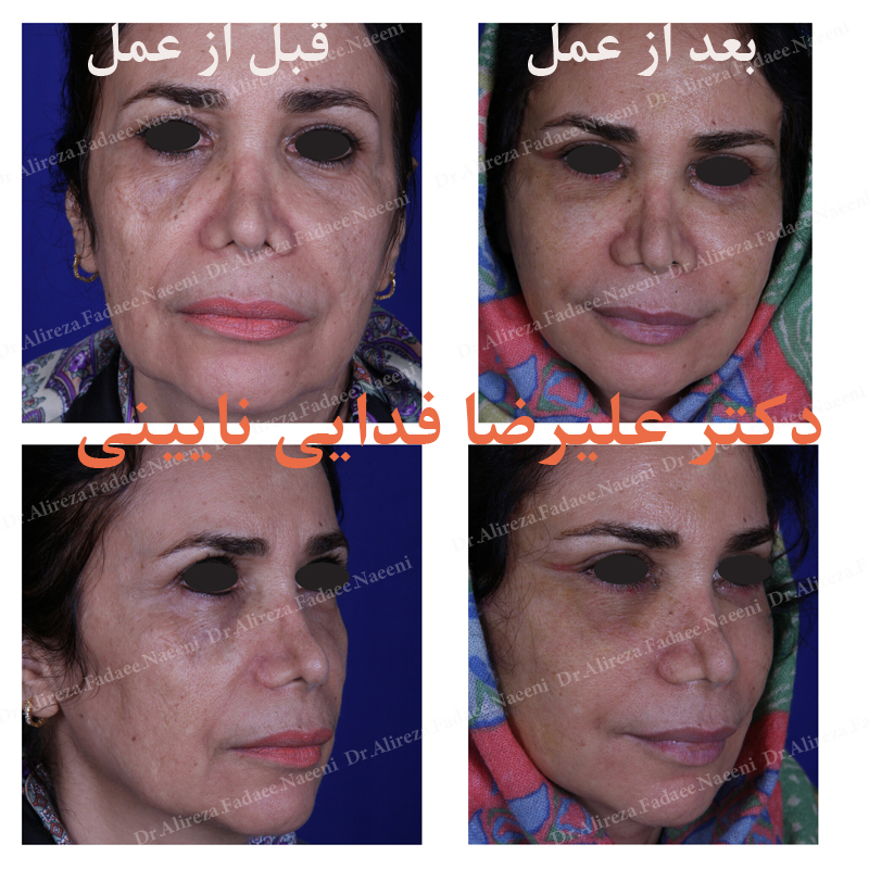 (لیفت صورت) دکتر علیرضا فدایی نایینی فوق تخصص جراحی پلاستیک 