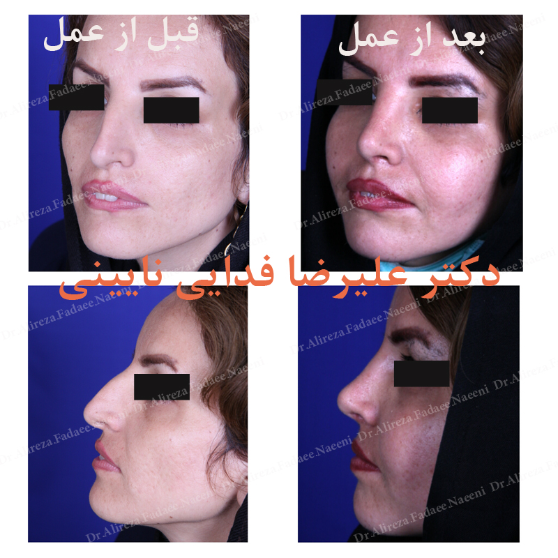 (عمل بینی) دکتر علیرضا فدایی نایینی فوق تخصص جراحی پلاستیک 