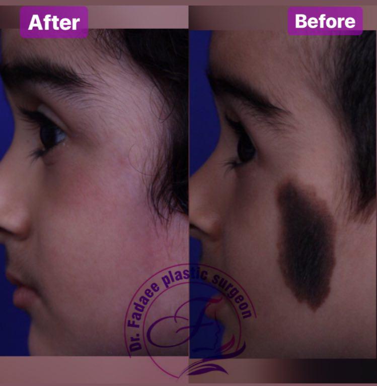 خال مادرزادی