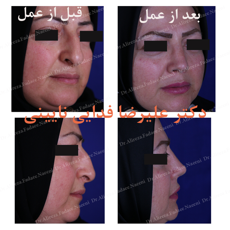 (عمل بینی) دکتر علیرضا فدایی نایینی فوق تخصص جراحی پلاستیک 