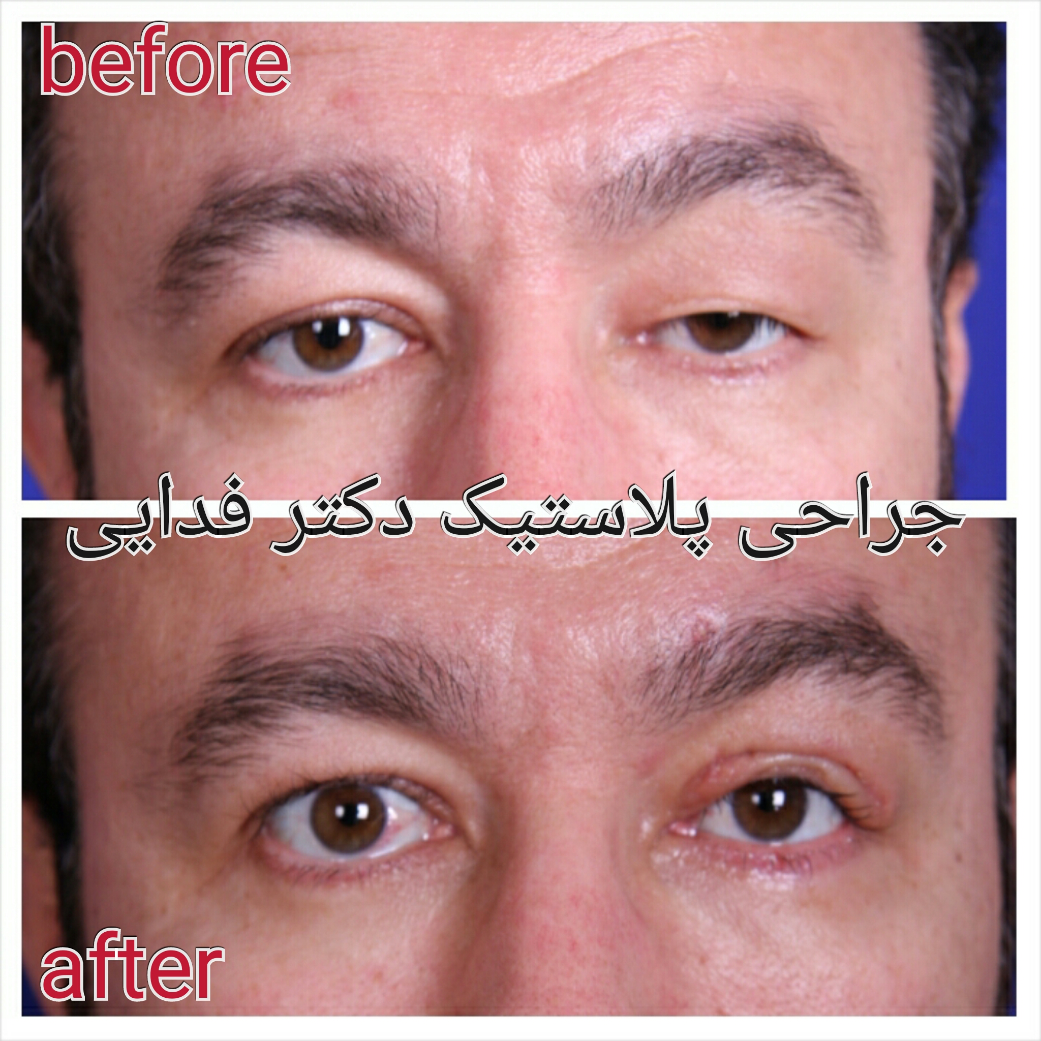 (پلک) دکتر علیرضا فدایی نایینی فوق تخصص جراحی پلاستیک 