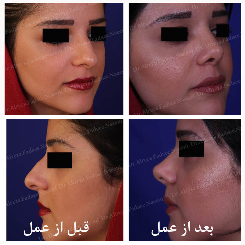 (عمل بینی) دکتر علیرضا فدایی نایینی فوق تخصص جراحی پلاستیک 