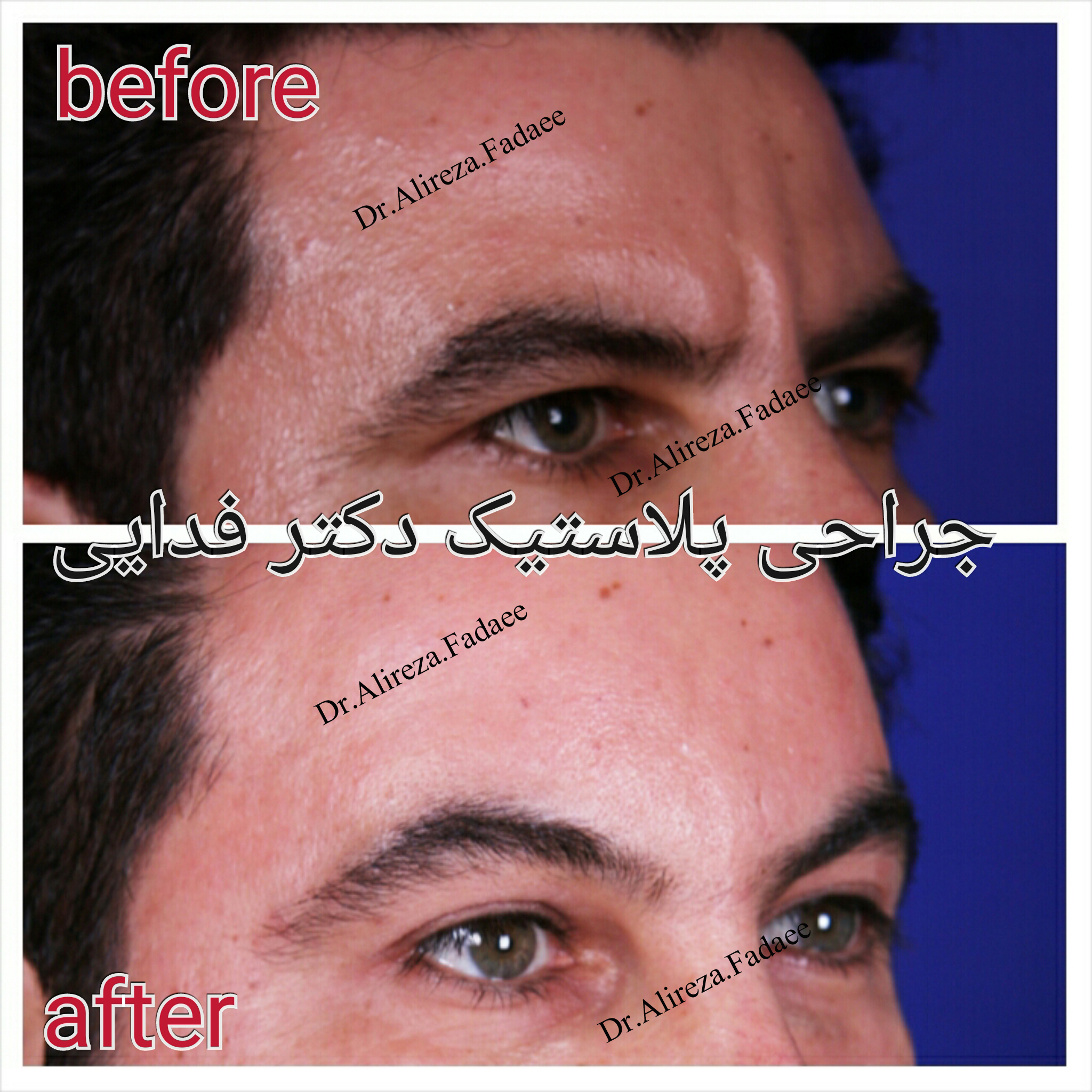 لیفت پیشانی  دکتر علیرضا فدایی نایینی فوق تخصص جراحی پلاستیک و زیبایی