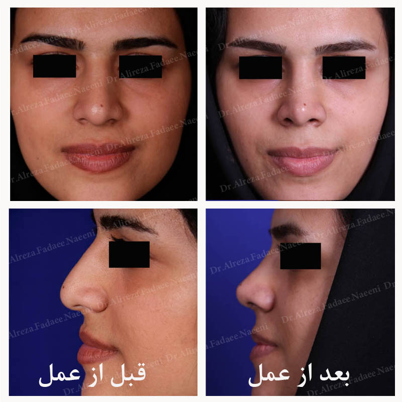 (عمل بینی) دکتر علیرضا فدایی نایینی فوق تخصص جراحی پلاستیک 