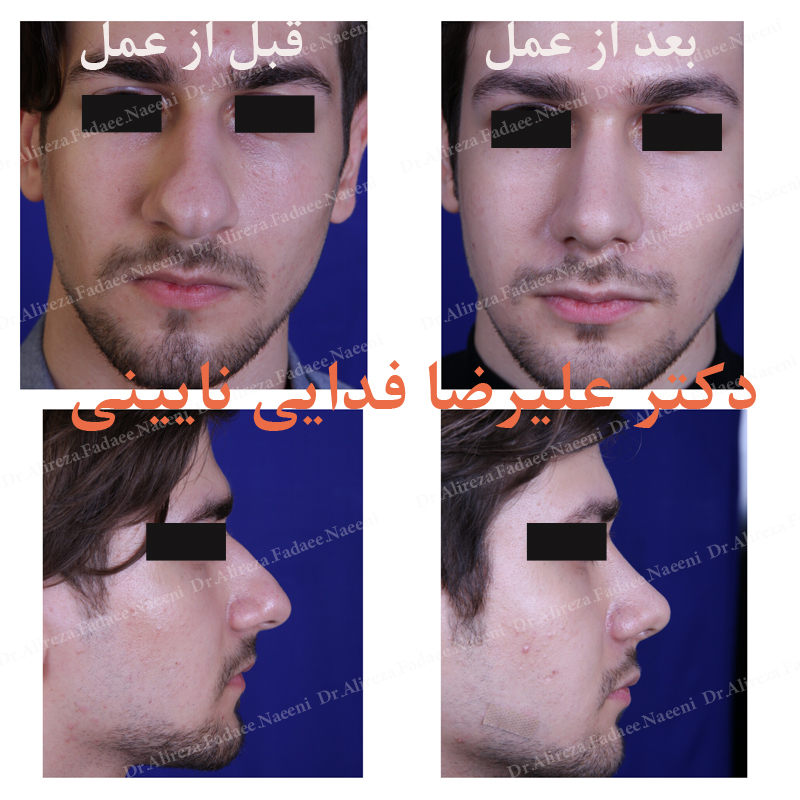 (عمل بینی) دکتر علیرضا فدایی نایینی فوق تخصص جراحی پلاستیک