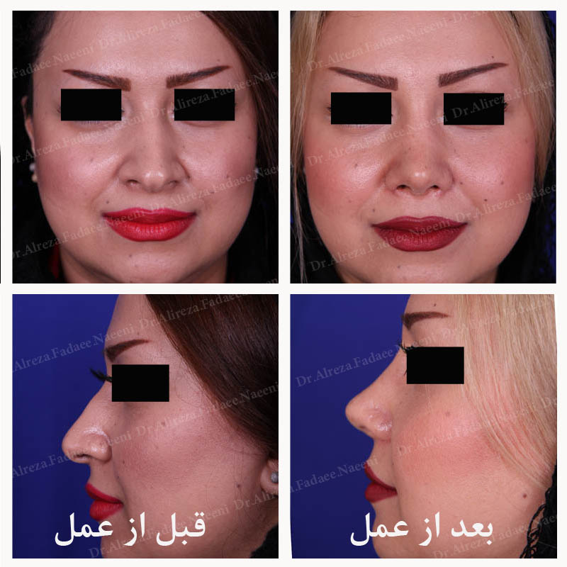 (عمل بینی) دکتر علیرضا فدایی نایینی فوق تخصص جراحی پلاستیک 