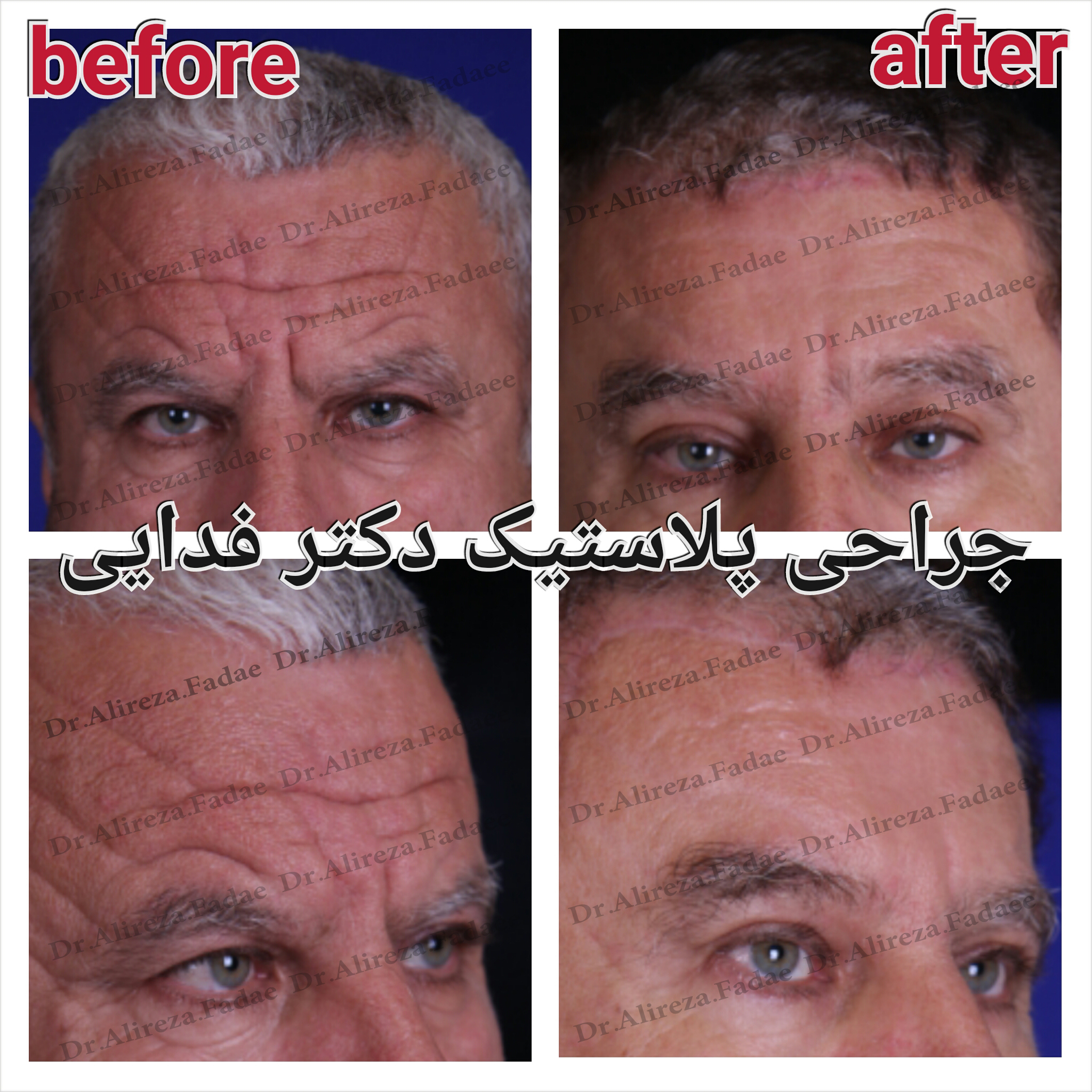 لیفت پیشانی  دکتر علیرضا فدایی نایینی فوق تخصص جراحی پلاستیک و زیبایی