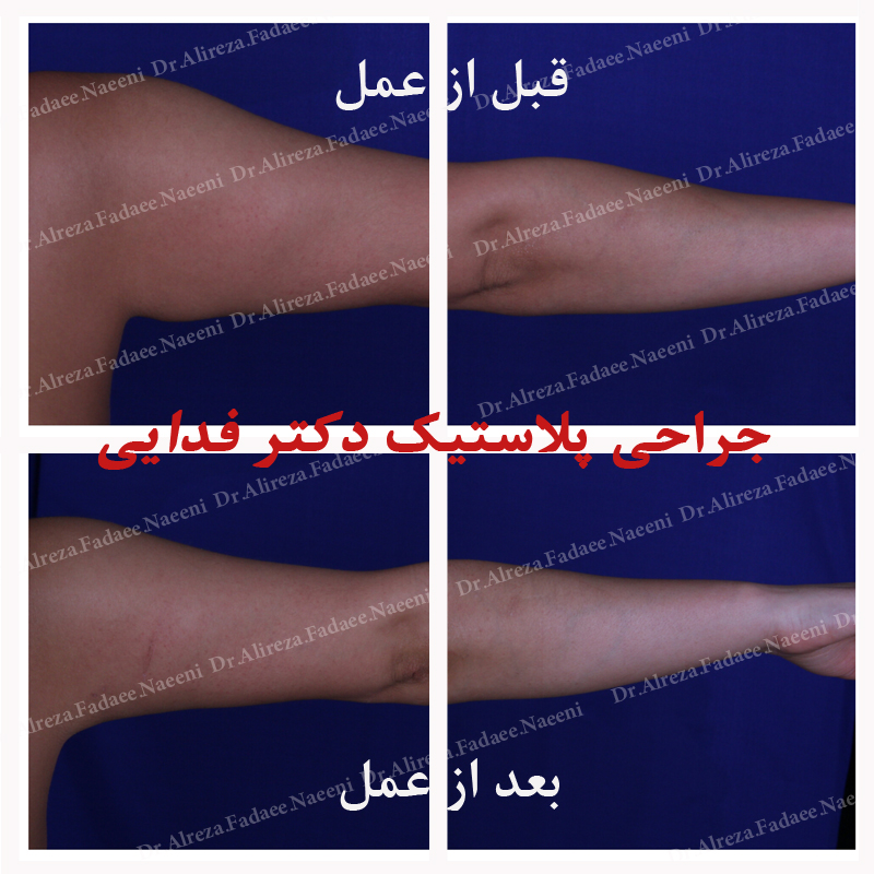 (لیپوماتیک بازو) دکتر علیرضا فدایی نایینی فوق تخصص جراحی پلاستیک