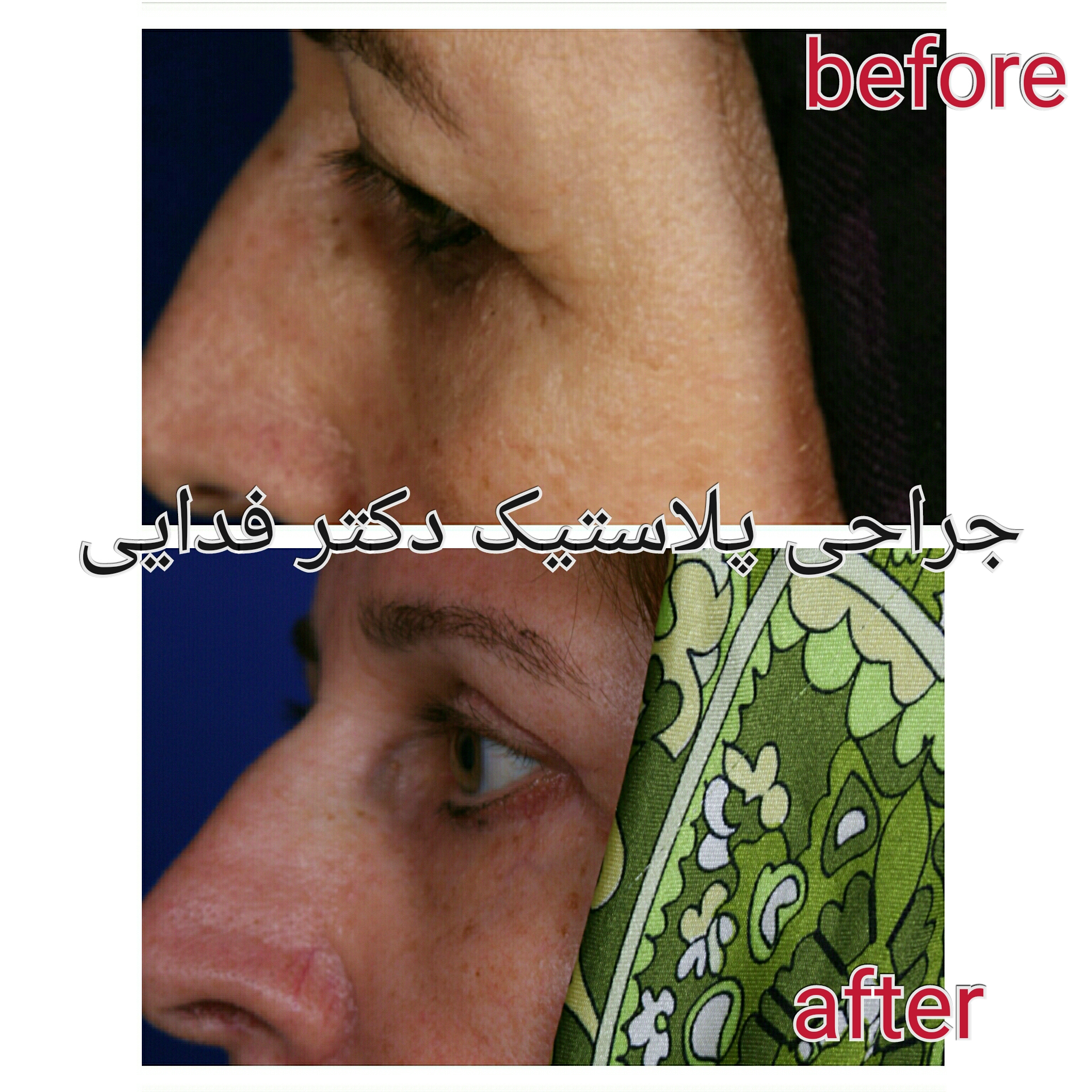 (پلک) دکتر علیرضا فدایی نایینی فوق تخصص جراحی پلاستیک 