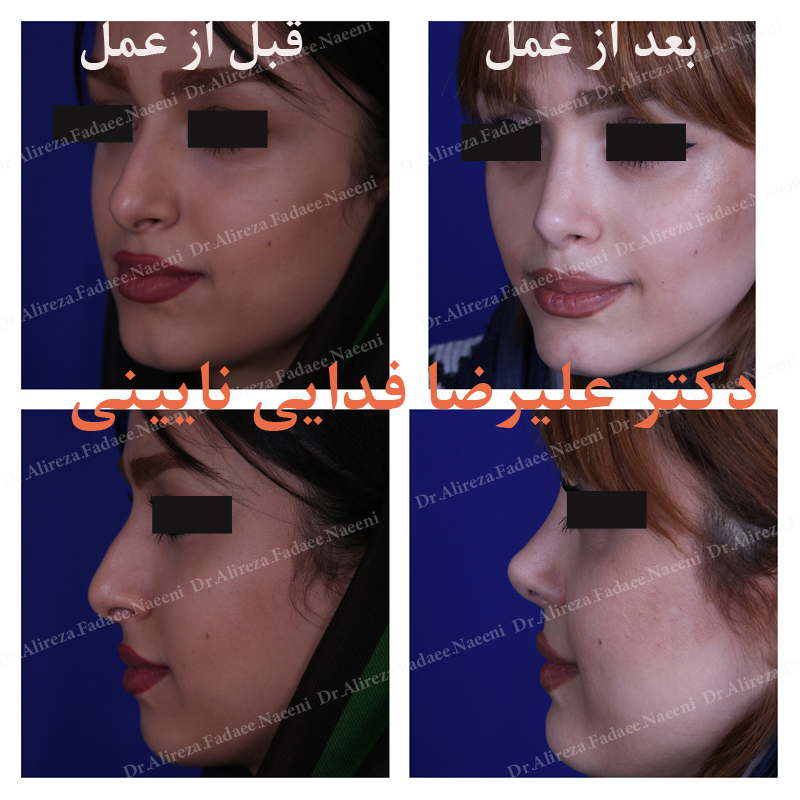 (عمل بینی) دکتر علیرضا فدایی نایینی فوق تخصص جراحی پلاستیک