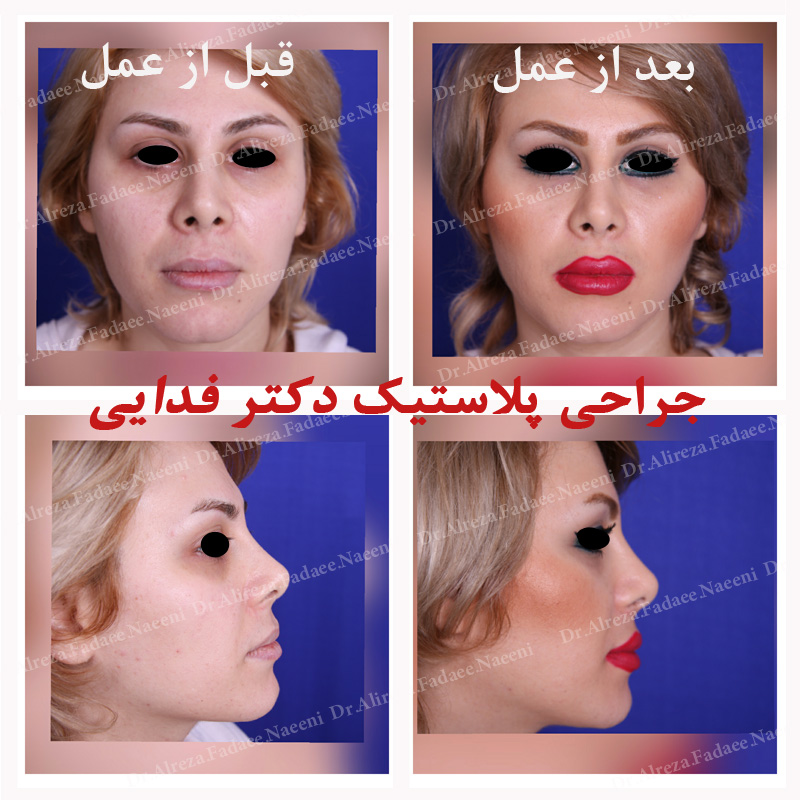  (تزریق چربی) دکتر علیرضا فدایی نایینی فوق تخصص جراحی پلاستیک  |