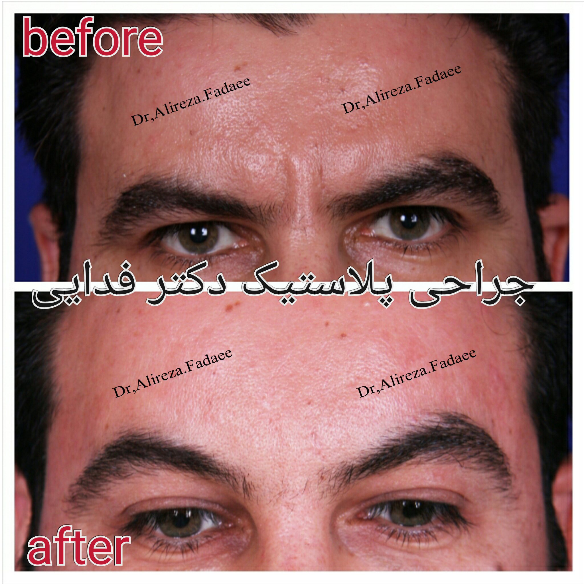 لیفت پیشانی  دکتر علیرضا فدایی نایینی فوق تخصص جراحی پلاستیک و زیبایی