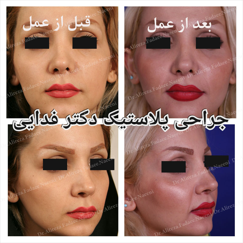 (پروتز گونه)دکتر علیرضا فدایی نایینی فوق تخصص جراحی پلاستیک و زیبایی  | 