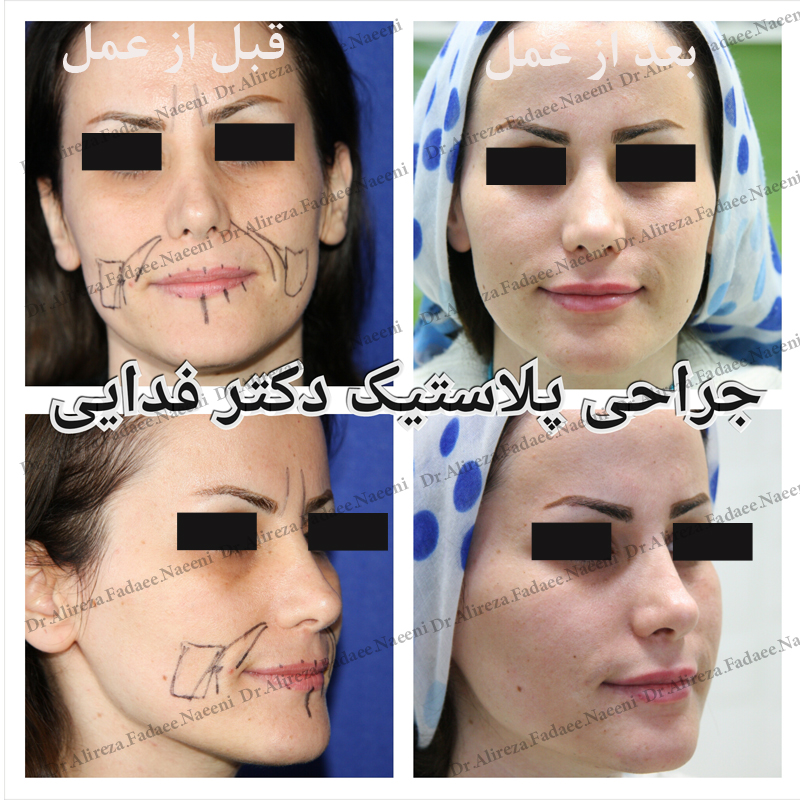 (تزریق چربی) دکتر علیرضا فدایی نایینی فوق تخصص جراحی پلاستیک