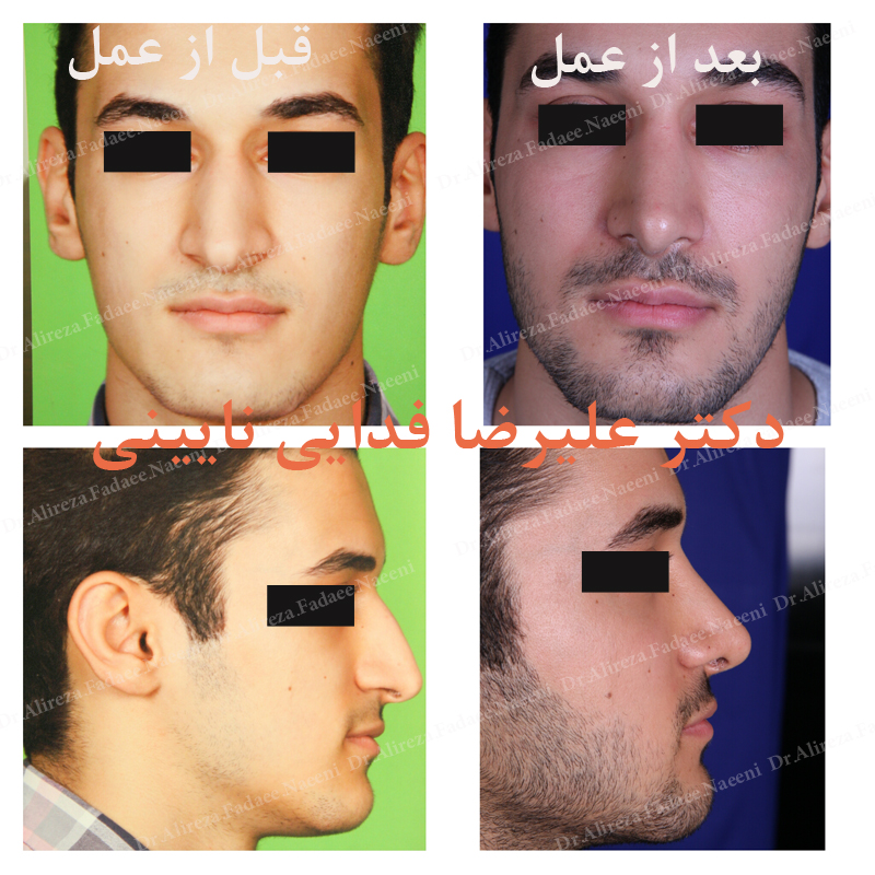 (عمل بینی) دکتر علیرضا فدایی نایینی فوق تخصص جراحی پلاستیک  |