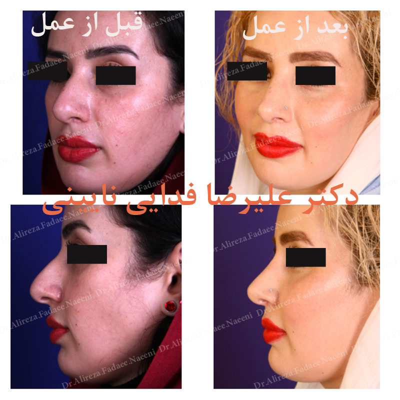 (پروتز گونه)دکتر علیرضا فدایی نایینی فوق تخصص جراحی پلاستیک و زیبایی 