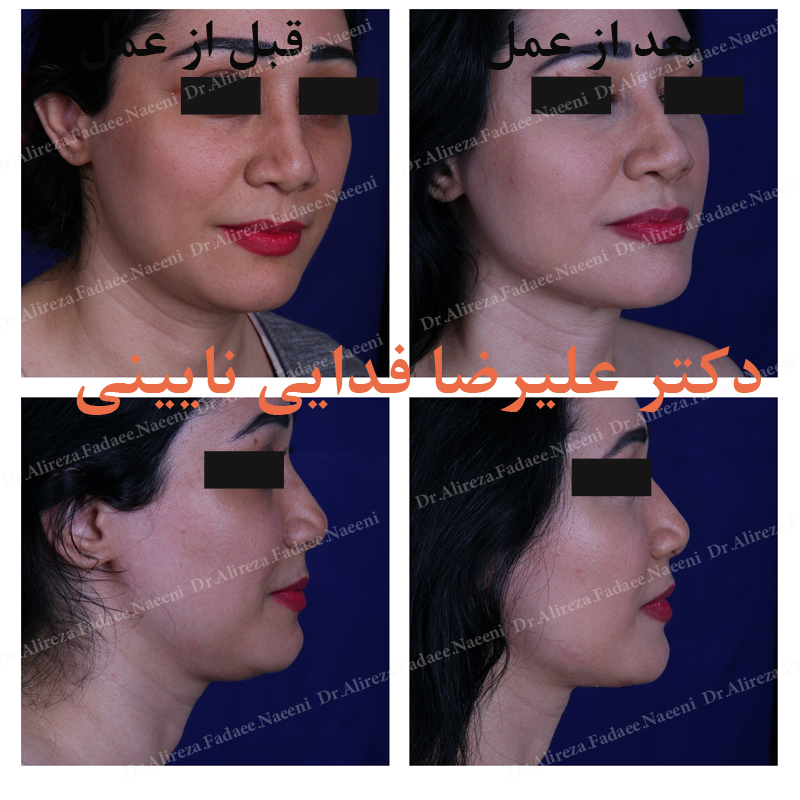 (لیپوماتیک غبغب) دکتر علیرضا فدایی نایینی فوق تخصص جراحی پلاستیک