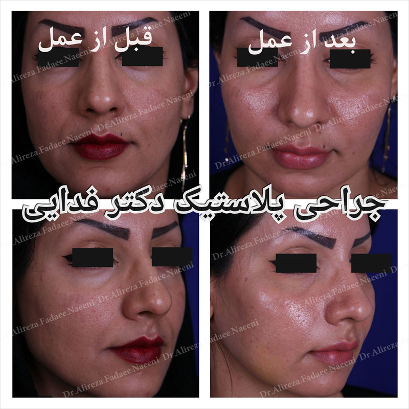 (پروتز گونه)دکتر علیرضا فدایی نایینی فوق تخصص جراحی پلاستیک و زیبایی  | 