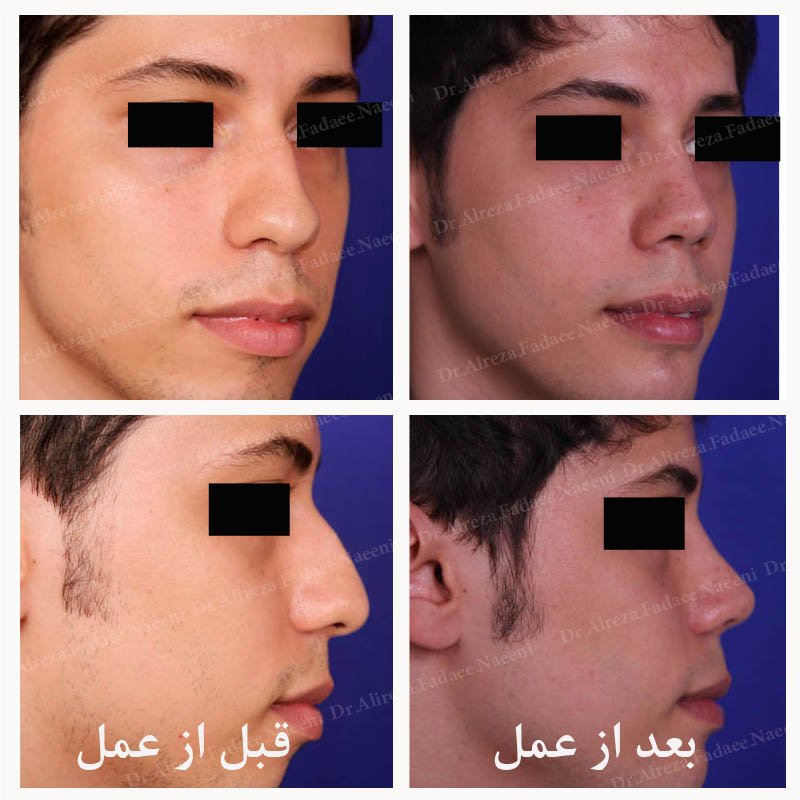 (عمل بینی) دکتر علیرضا فدایی نایینی فوق تخصص جراحی پلاستیک 