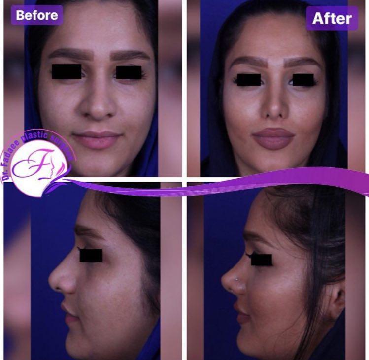 عمل بینی به همراه تزریق چربی