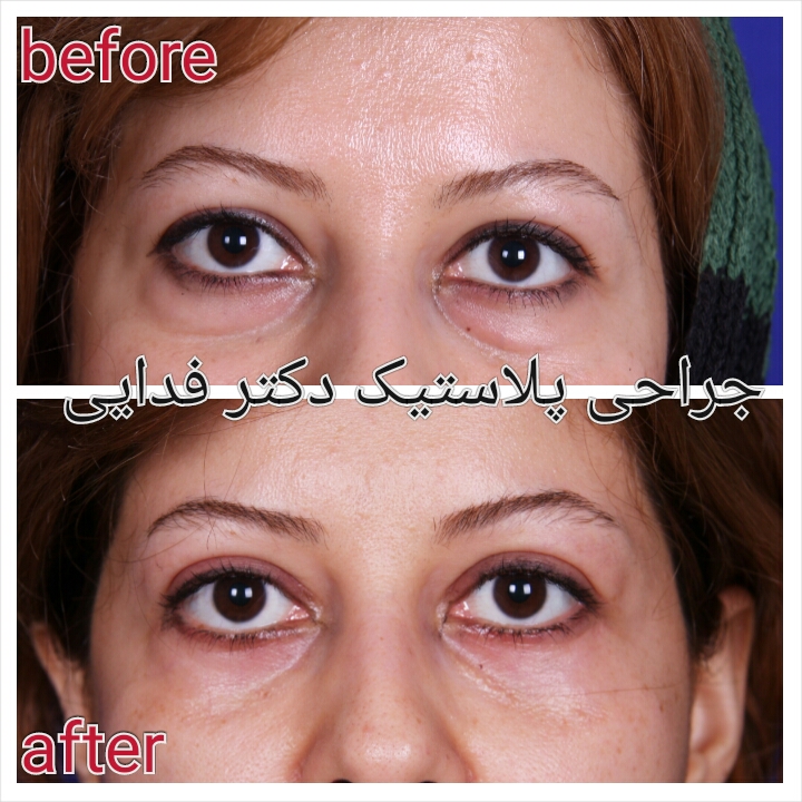 (پلک) دکتر علیرضا فدایی نایینی فوق تخصص جراحی پلاستیک 