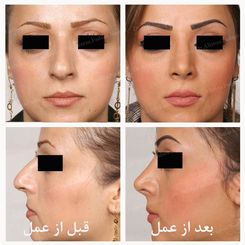 (عمل بینی) دکتر علیرضا فدایی نایینی فوق تخصص جراحی پلاستیک 