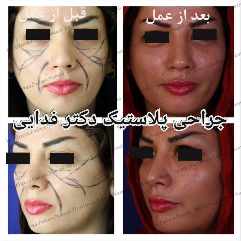 (تزریق چربی) دکتر علیرضا فدایی نایینی فوق تخصص جراحی پلاستیک