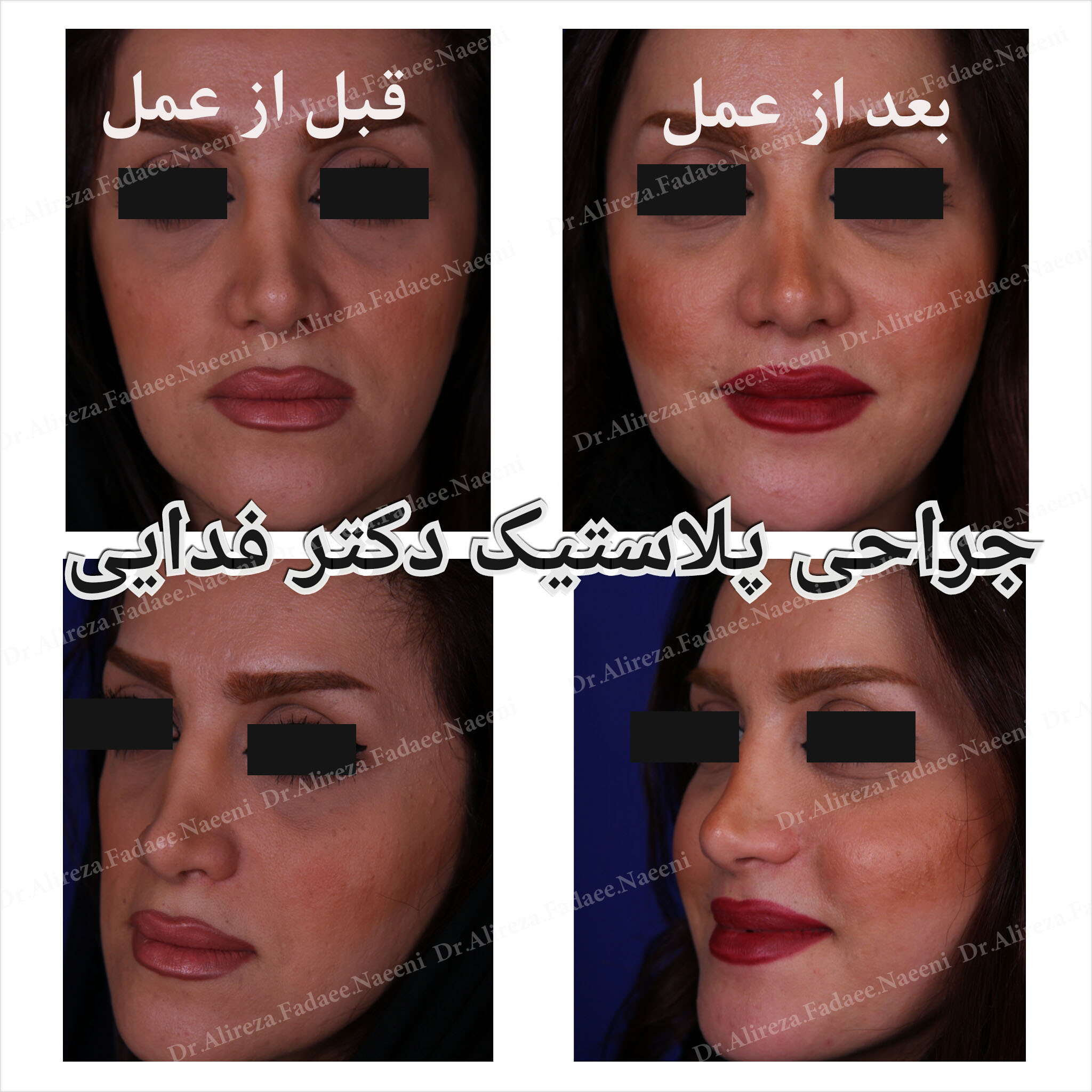 (تزریق چربی) دکتر علیرضا فدایی نایینی فوق تخصص جراحی پلاستیک