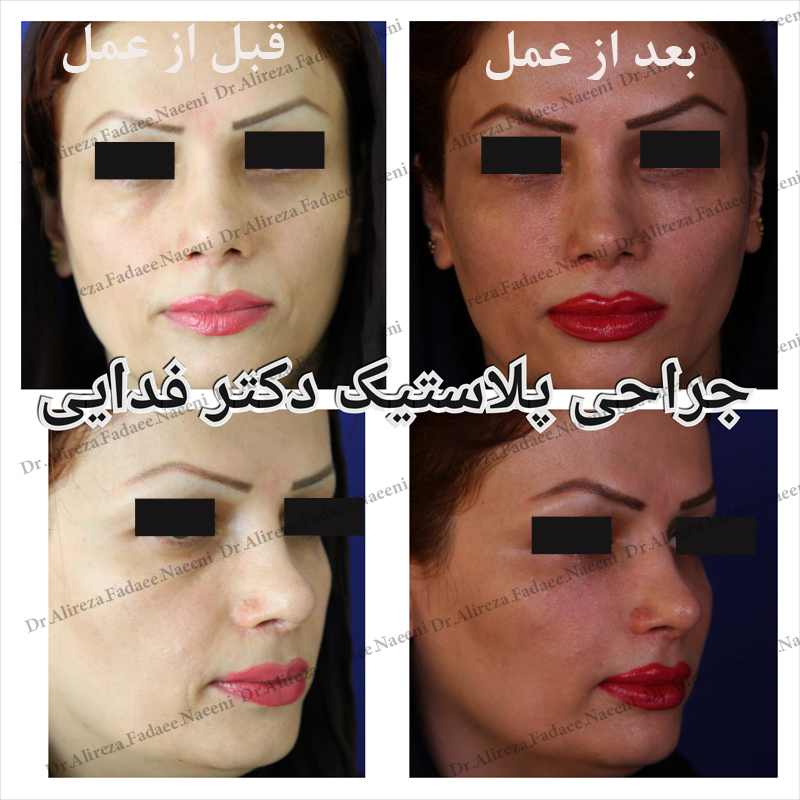 (تزریق چربی) دکتر علیرضا فدایی نایینی فوق تخصص جراحی پلاستیک