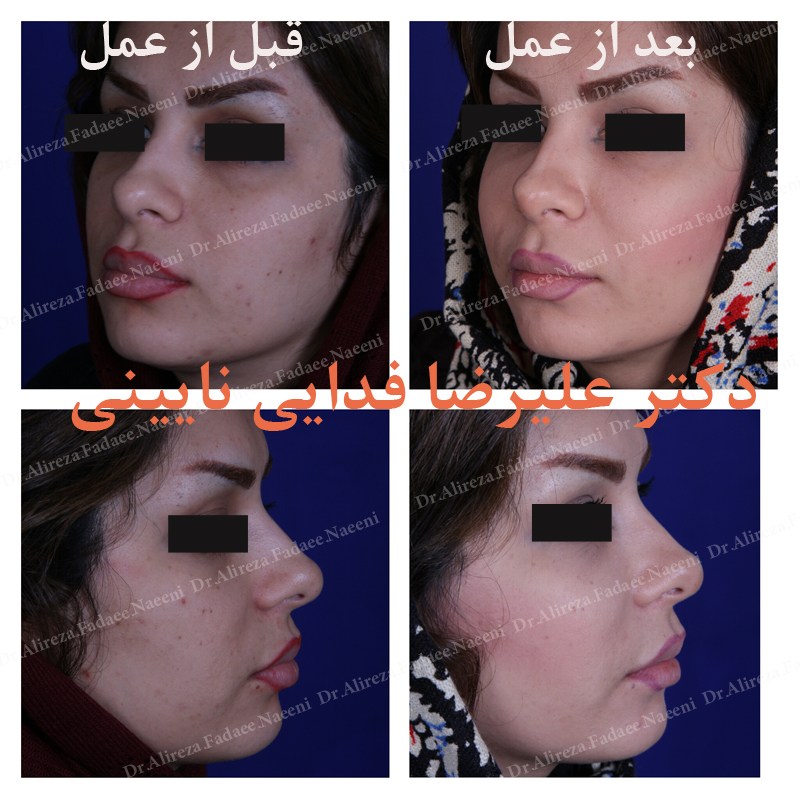 (تزریق چربی) دکتر علیرضا فدایی نایینی فوق تخصص جراحی پلاستیک