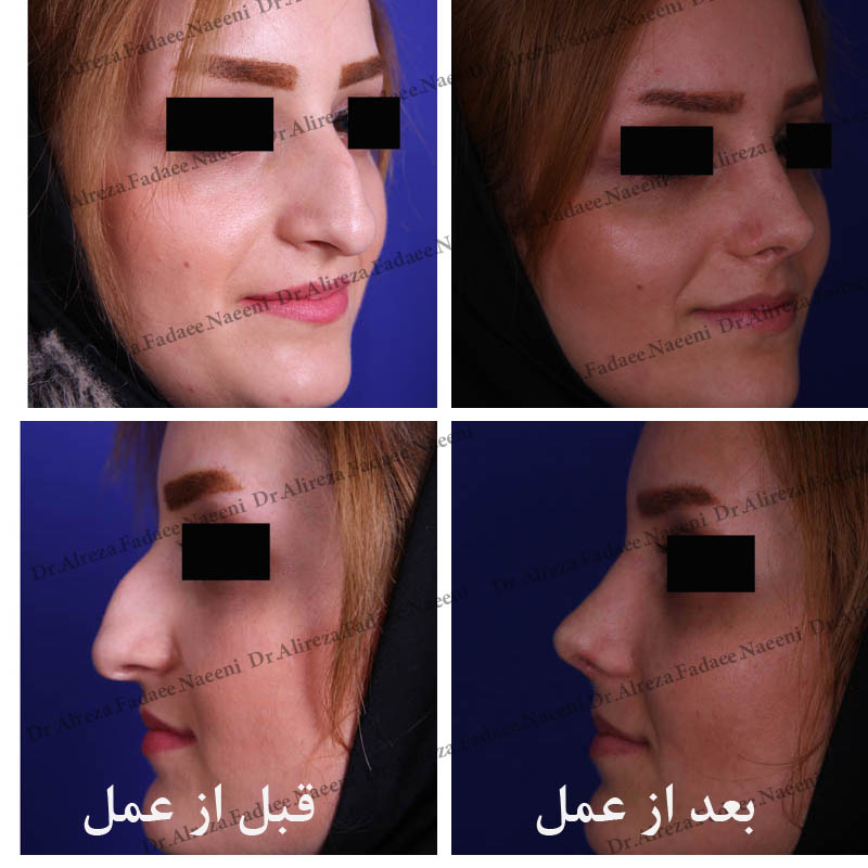 (عمل بینی) دکتر علیرضا فدایی نایینی فوق تخصص جراحی پلاستیک 