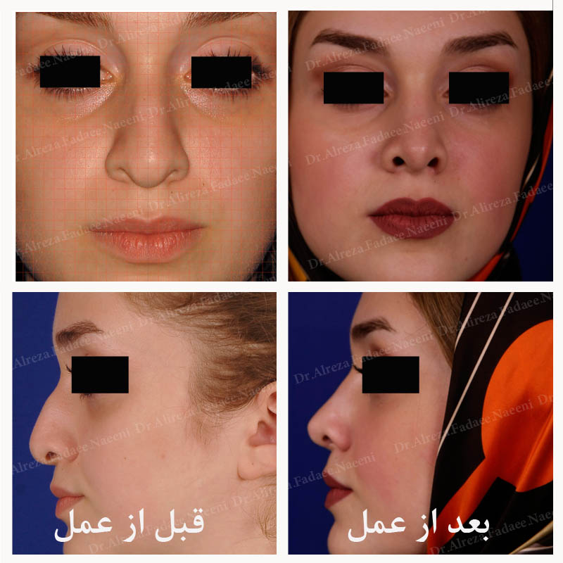 (عمل بینی) دکتر علیرضا فدایی نایینی فوق تخصص جراحی پلاستیک 