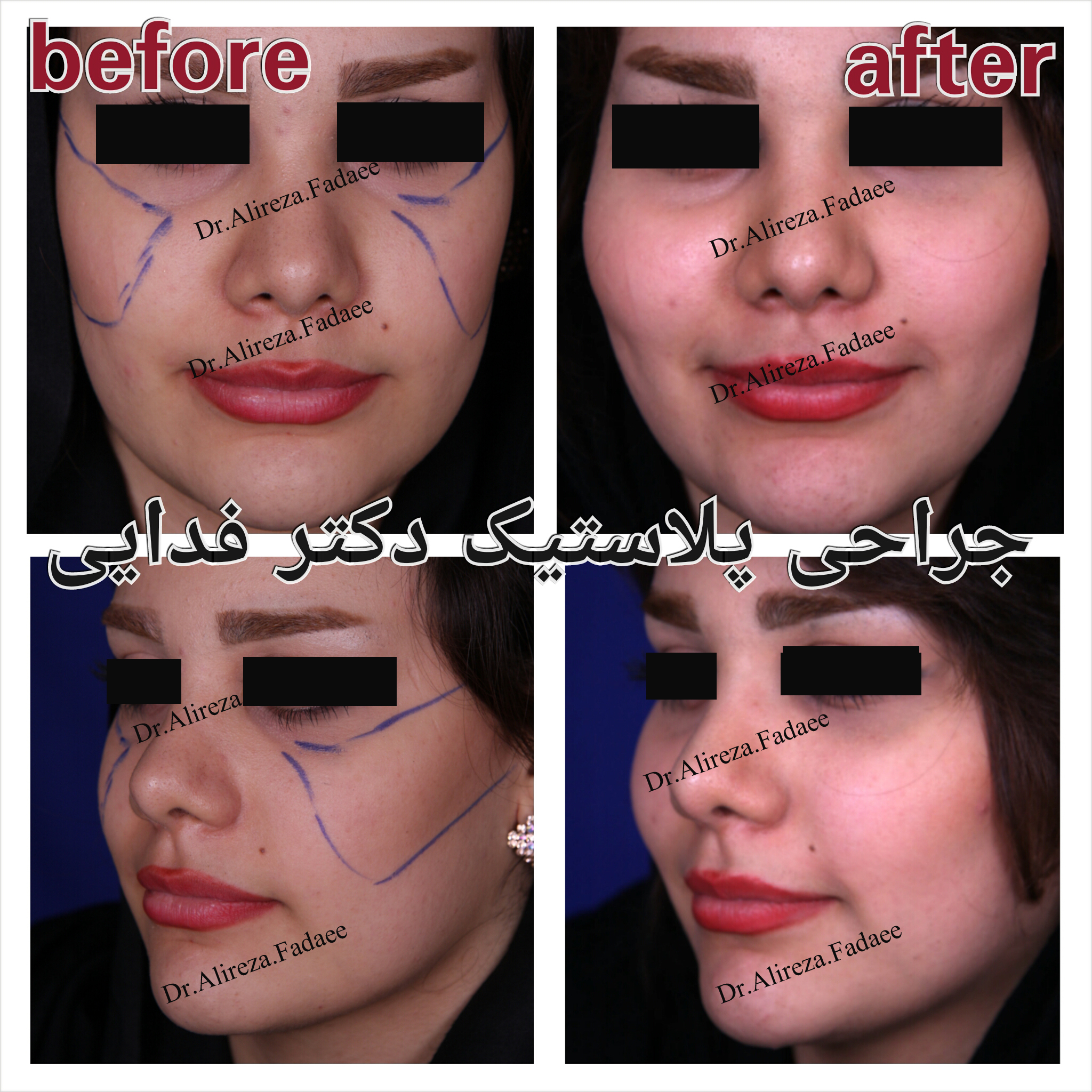 (تزریق چربی) دکتر علیرضا فدایی نایینی فوق تخصص جراحی پلاستیک