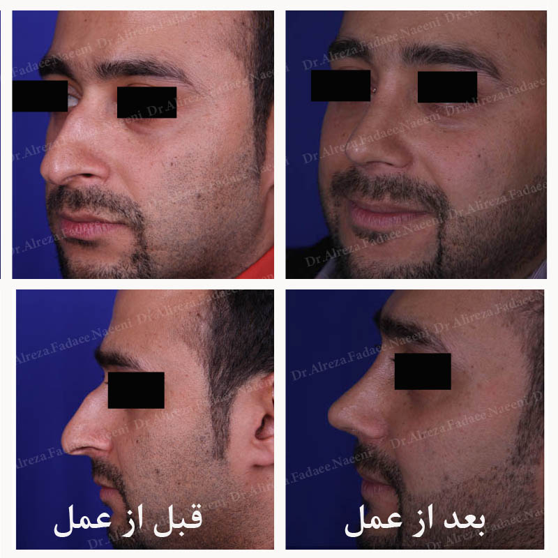 (عمل بینی) دکتر علیرضا فدایی نایینی فوق تخصص جراحی پلاستیک 