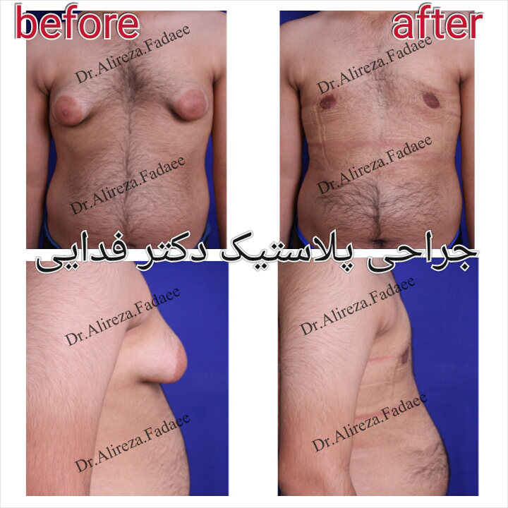 (ژنیکوماستی) دکتر علیرضا فدایی نایینی فوق تخصص جراحی پلاستیک